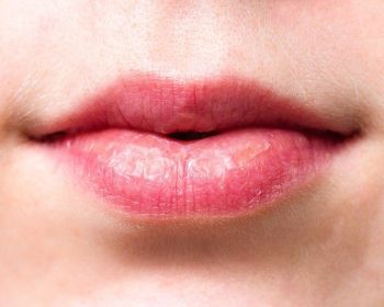 Wrinkles Above the Lips: The Best Treatments & Prevention